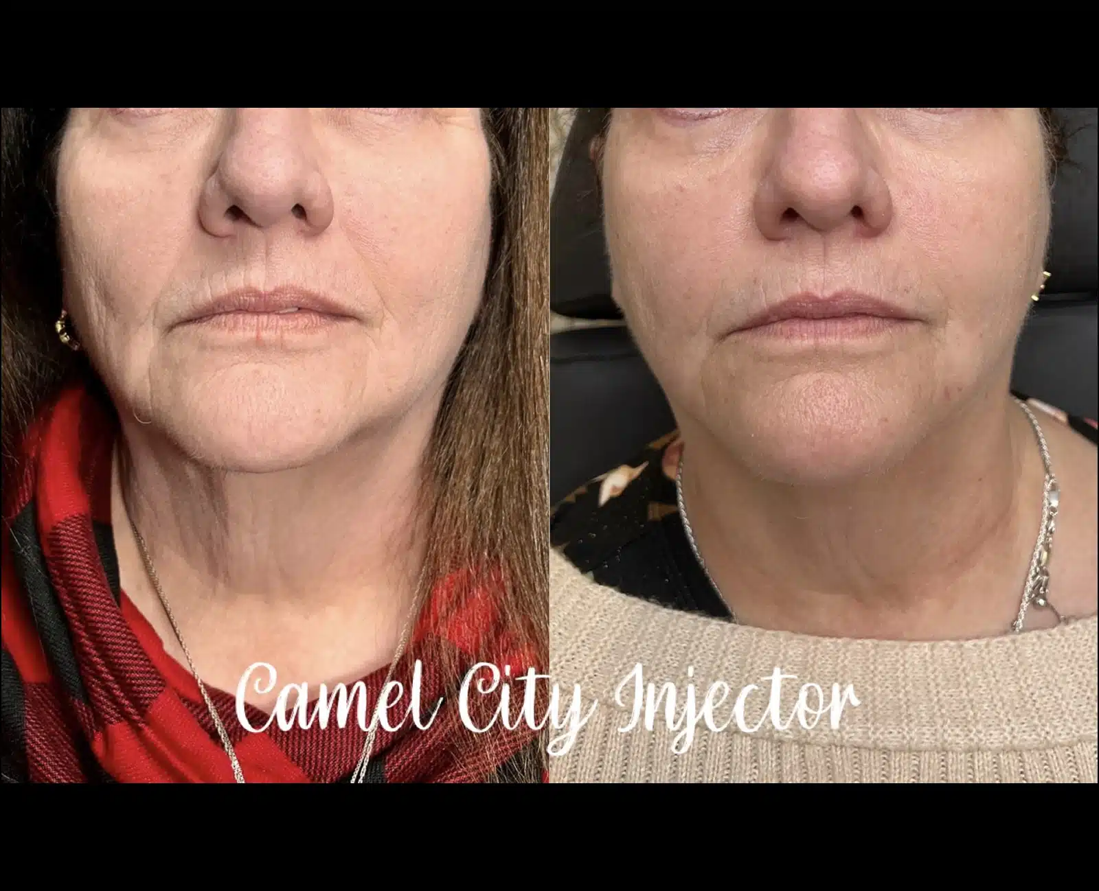 Botox for Every Age