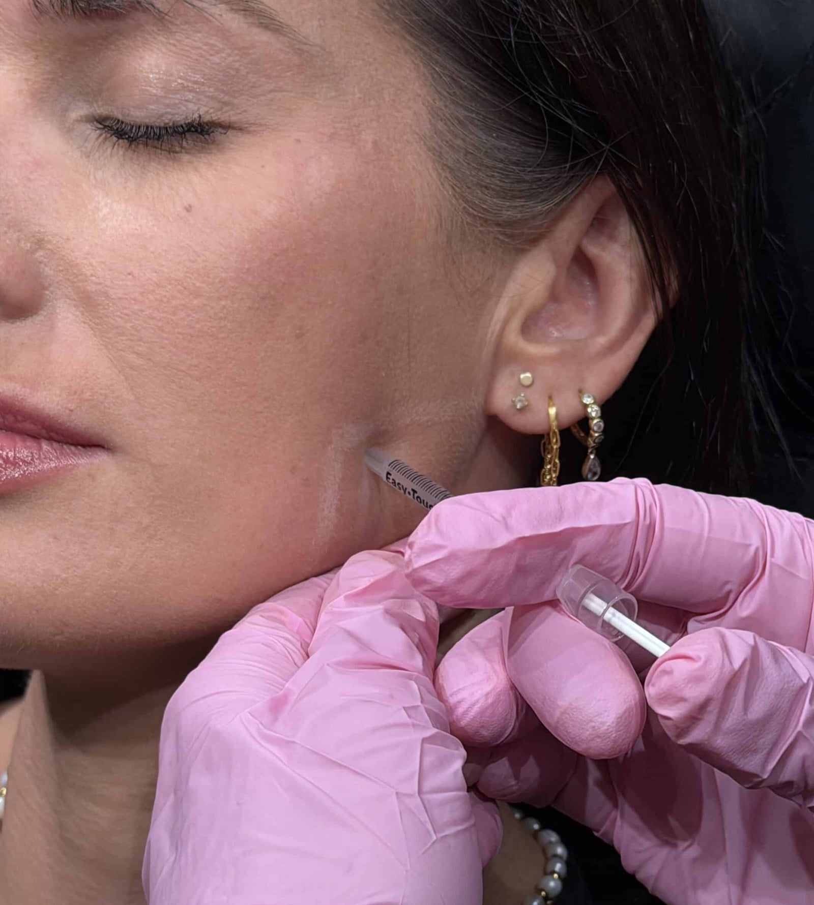 Chemical Peels Treat