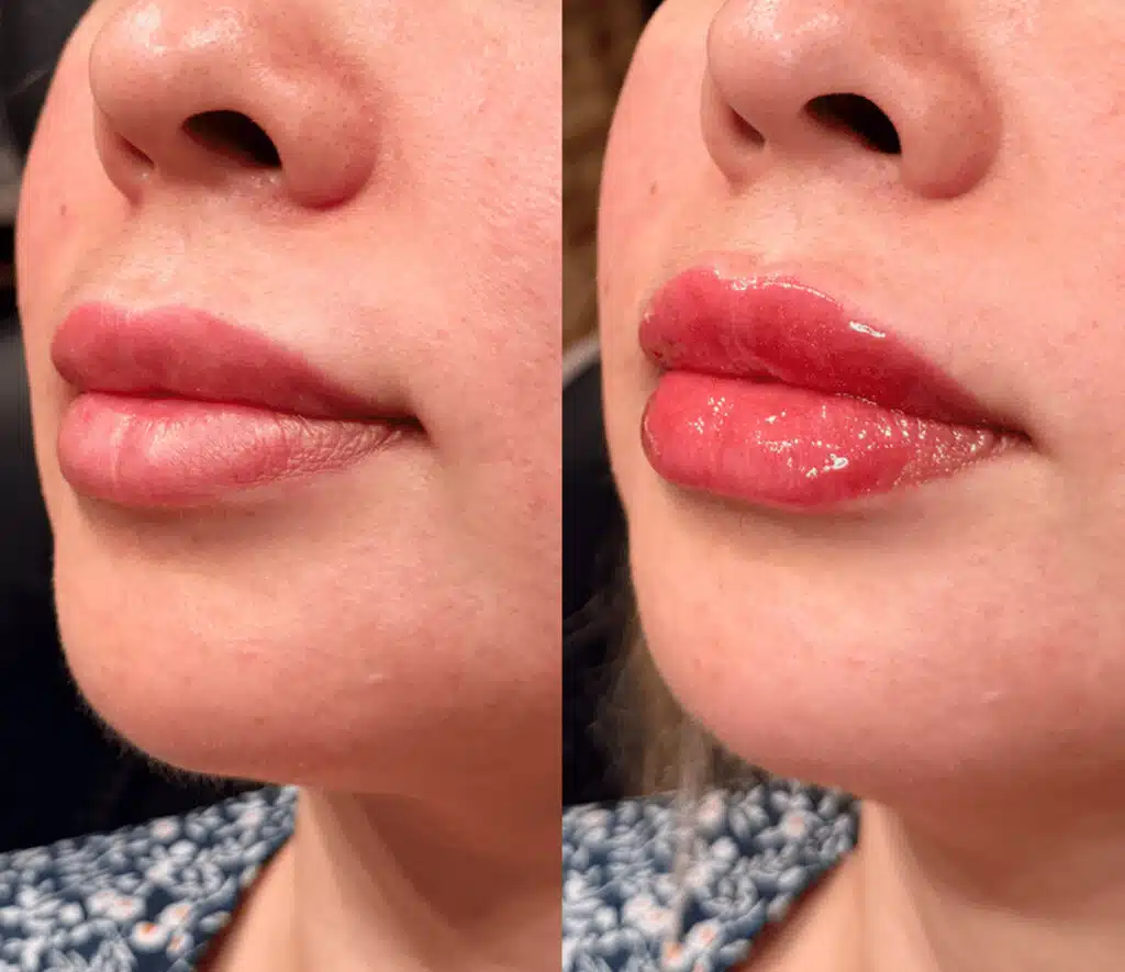 Medical spa treatments in King, NC – Botox, fillers and laser treatments