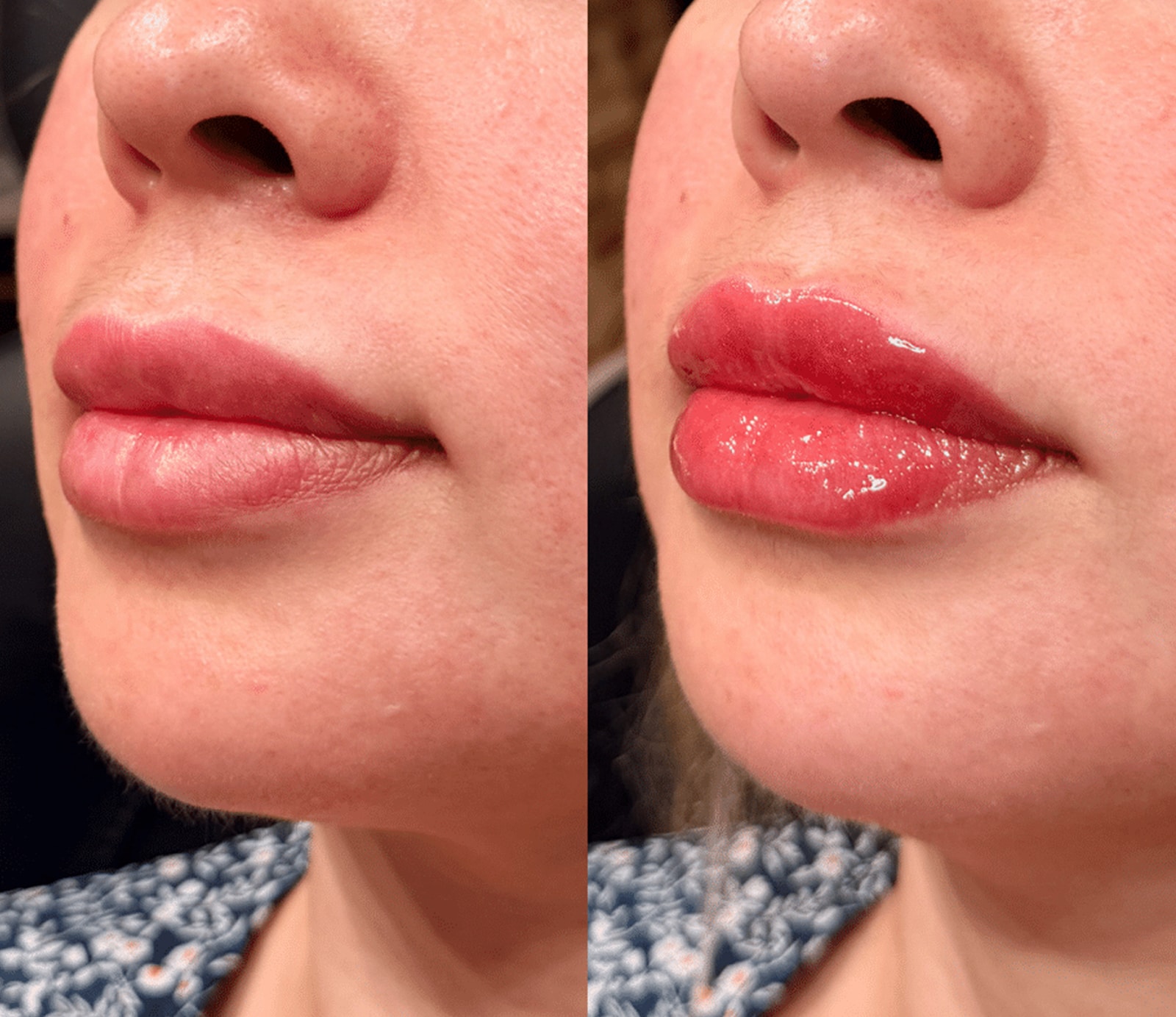 Camel City Injector is Your Premier Destination lip filler winston salem