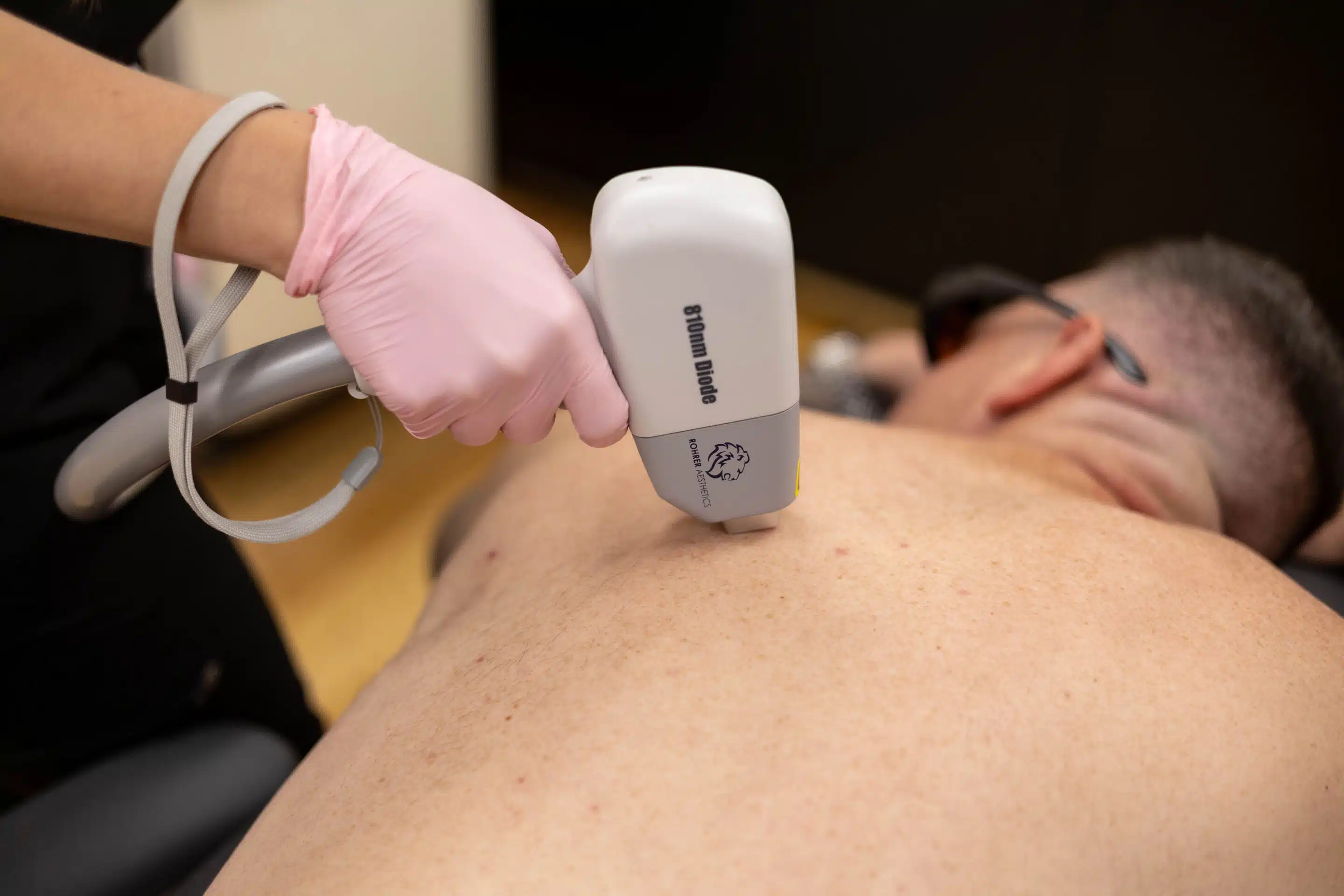 Laser hair removal on the back at Camel City Injector