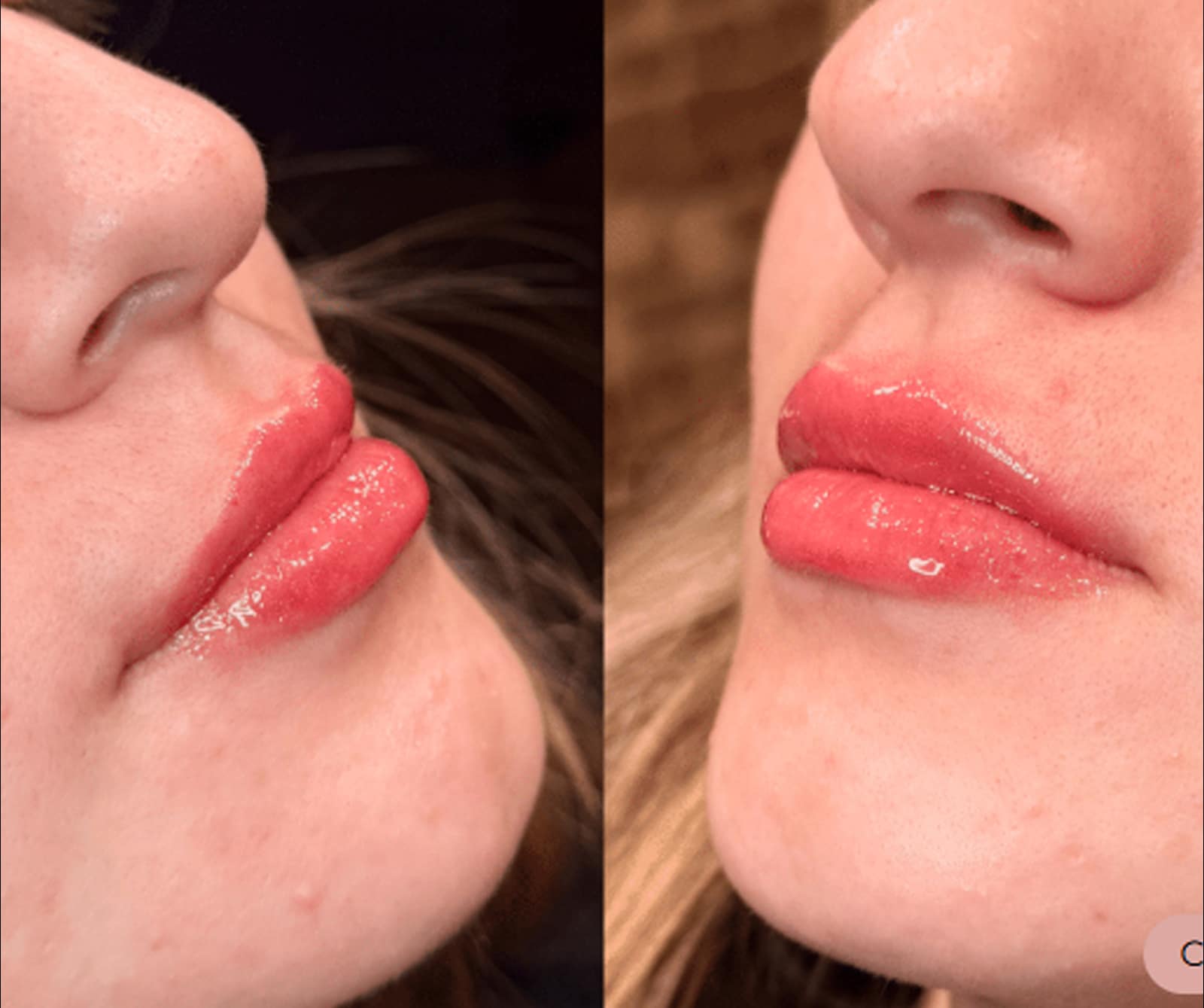Expect During the Injection Shaping and Contouring with Daxxify