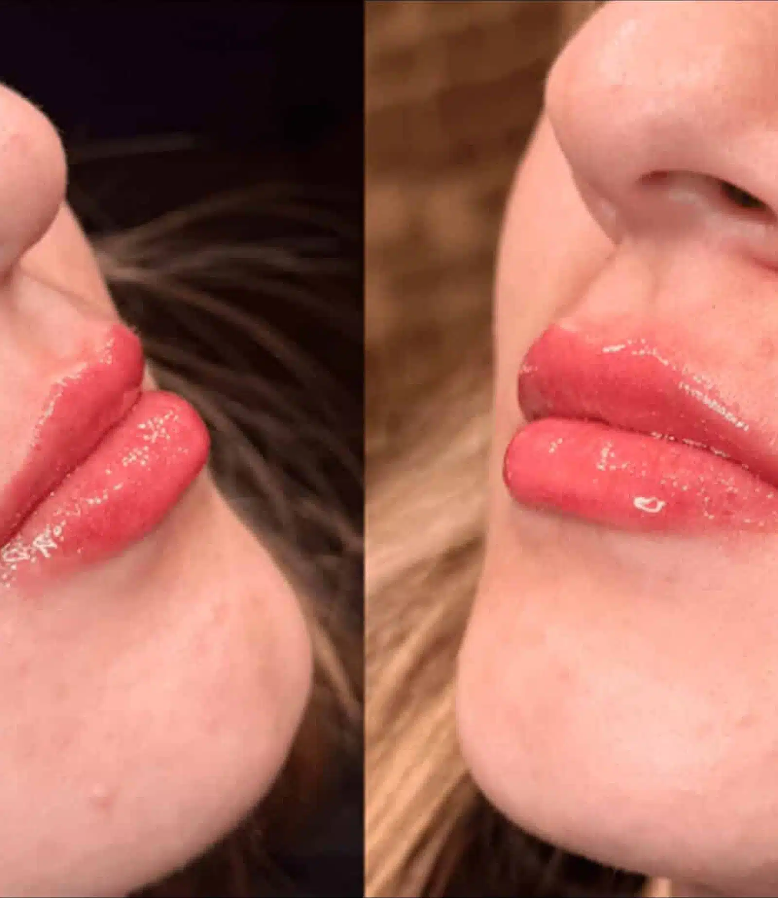 Expect During the Injection Shaping and Contouring with Daxxify