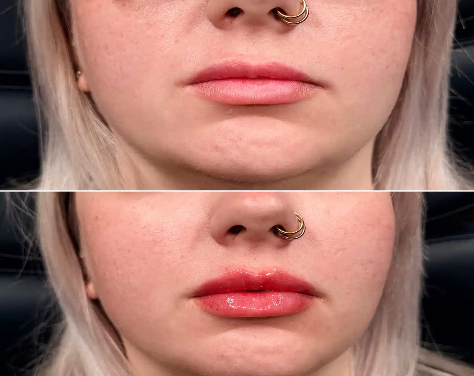 First Step Toward a Refreshed You lip filler winston salem