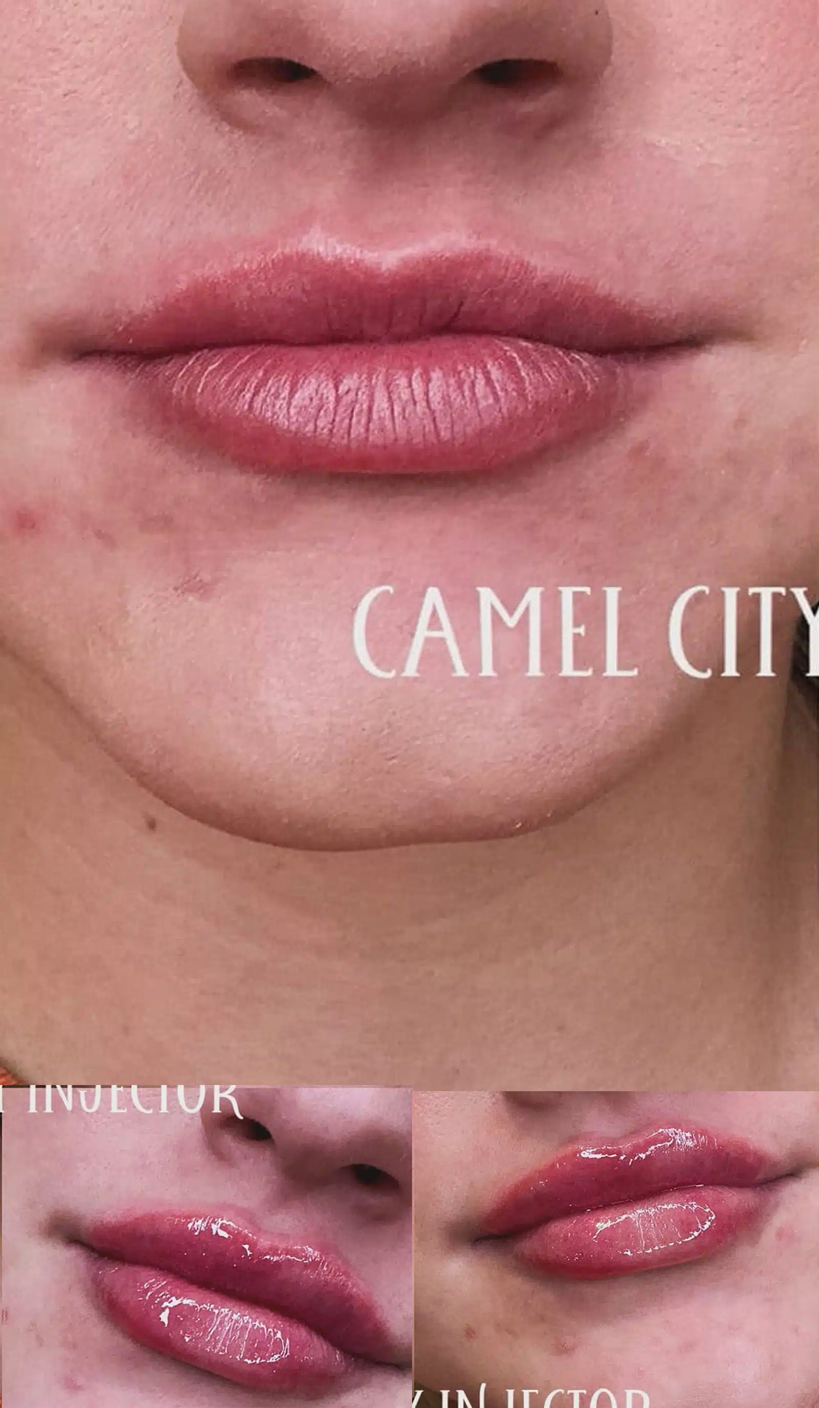 Fuller, More Defined Lips dermal filler designed to redefine