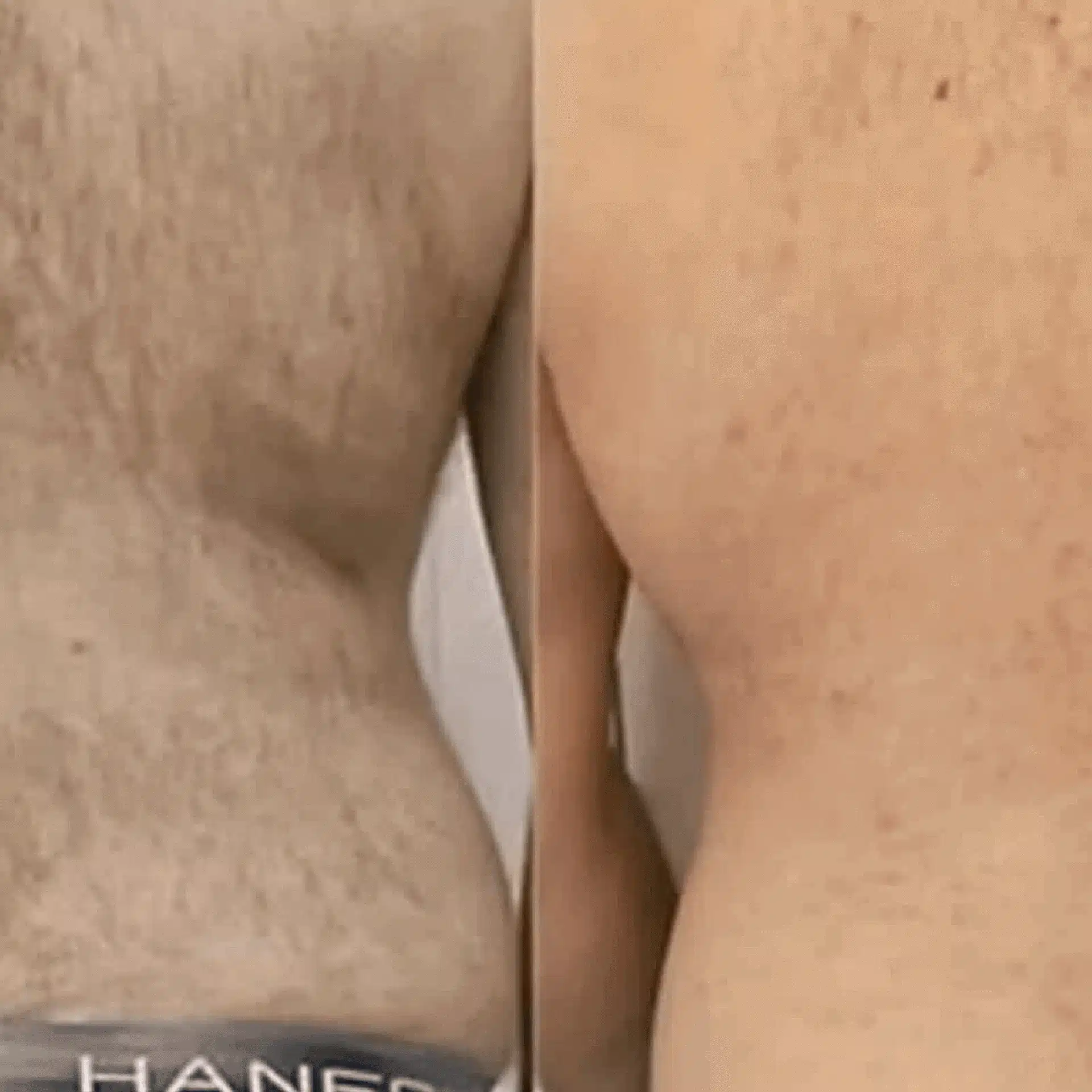 Laser Hair Removal tattoo removal
