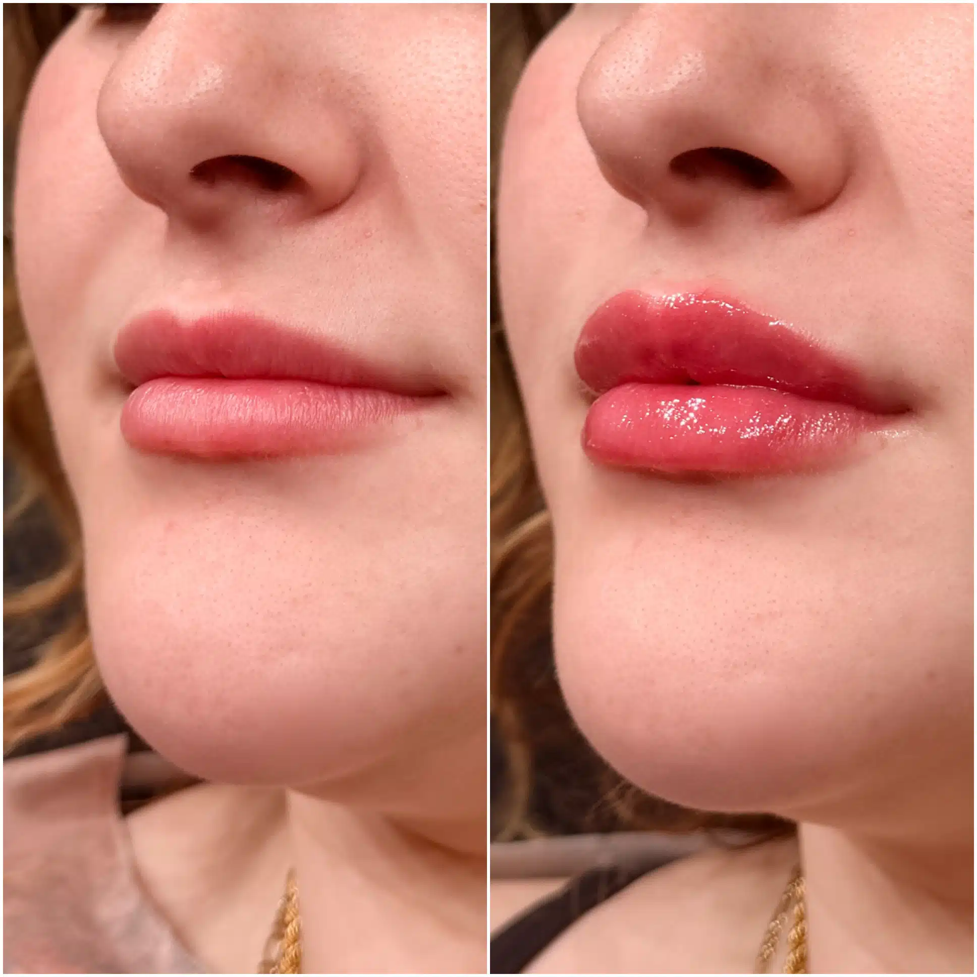 Lip Filler King