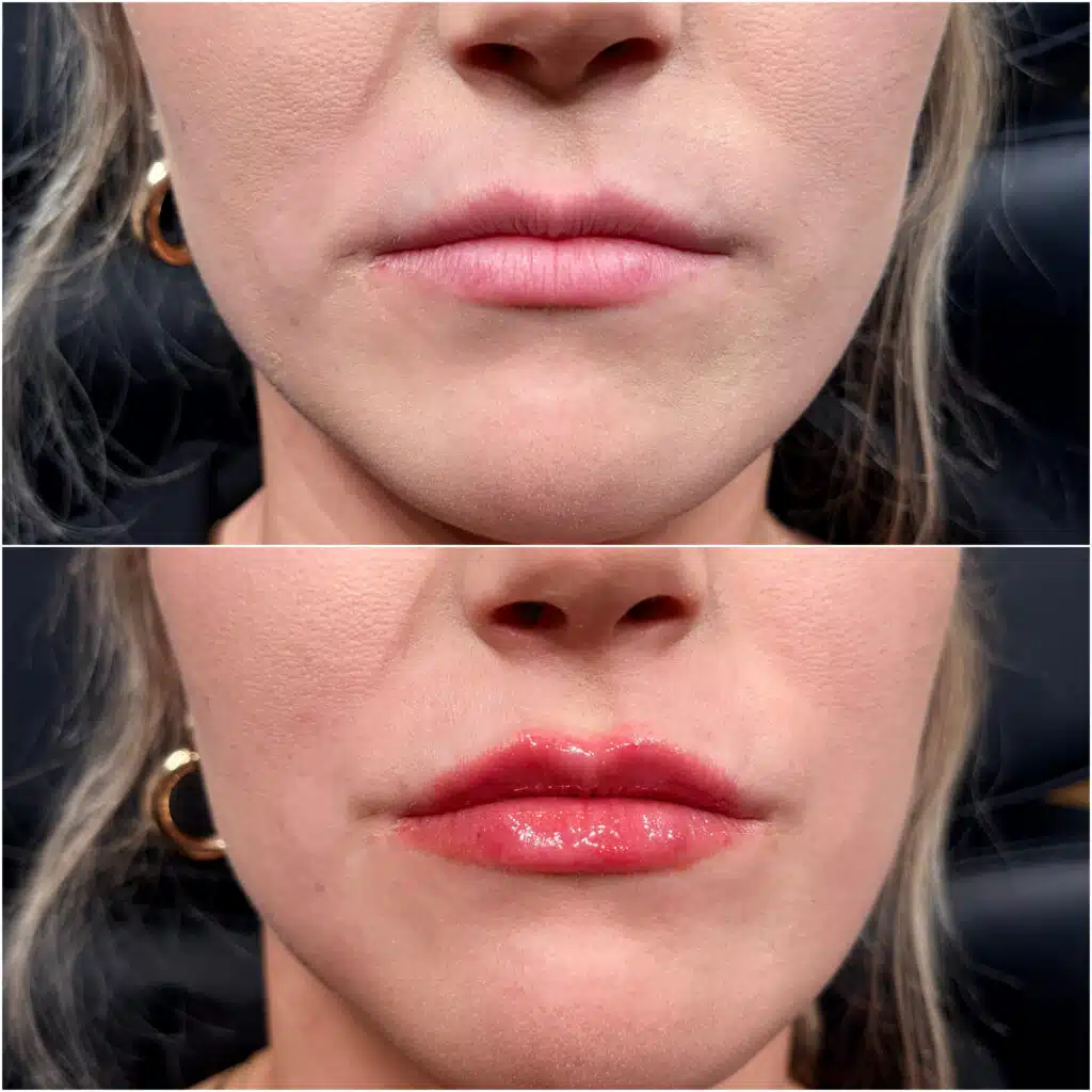 Upper lip close-up at Camel City Injector
