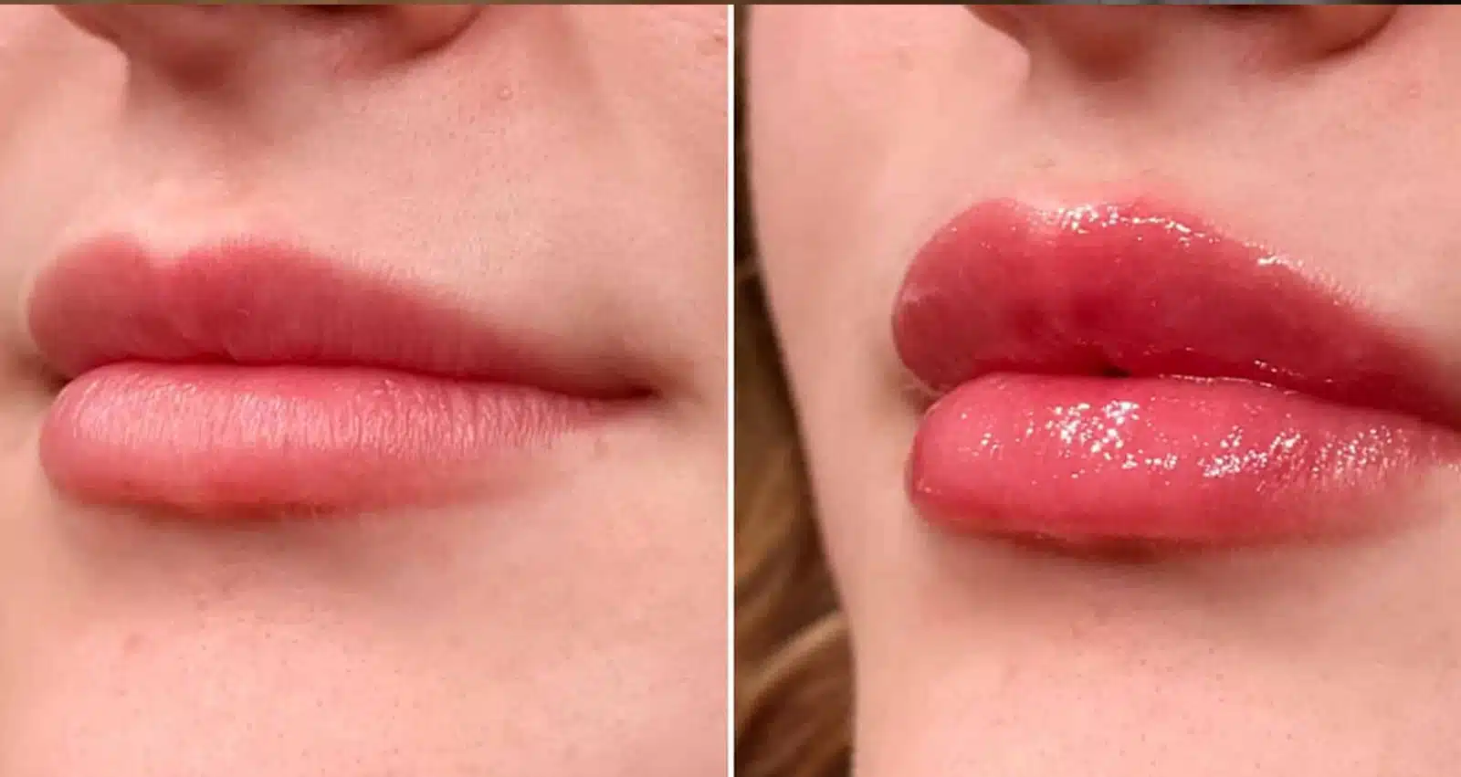 Lip Filler King