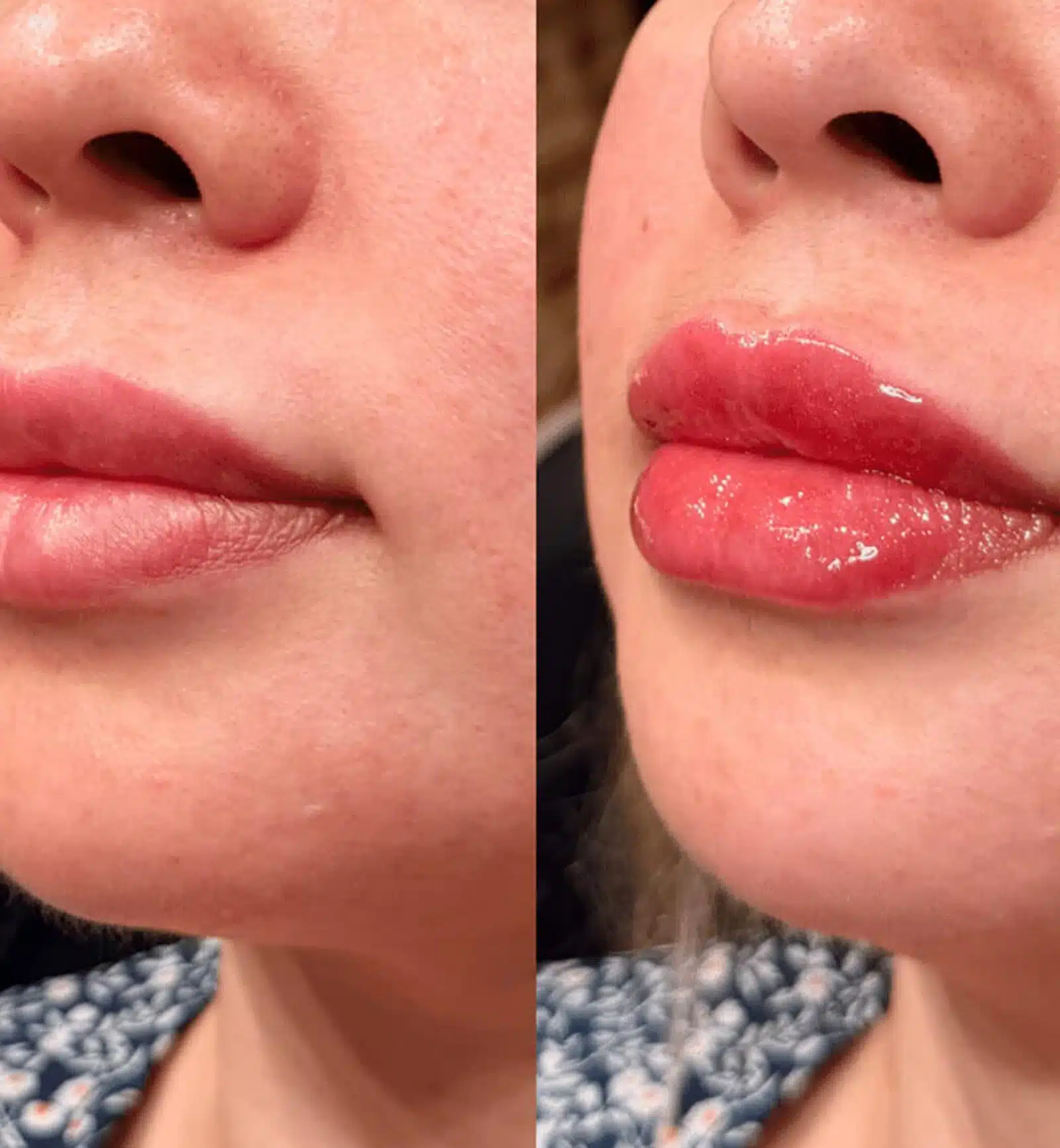 Natural-Looking Results Start With a Personalized Plan dermal filler designed to redefine