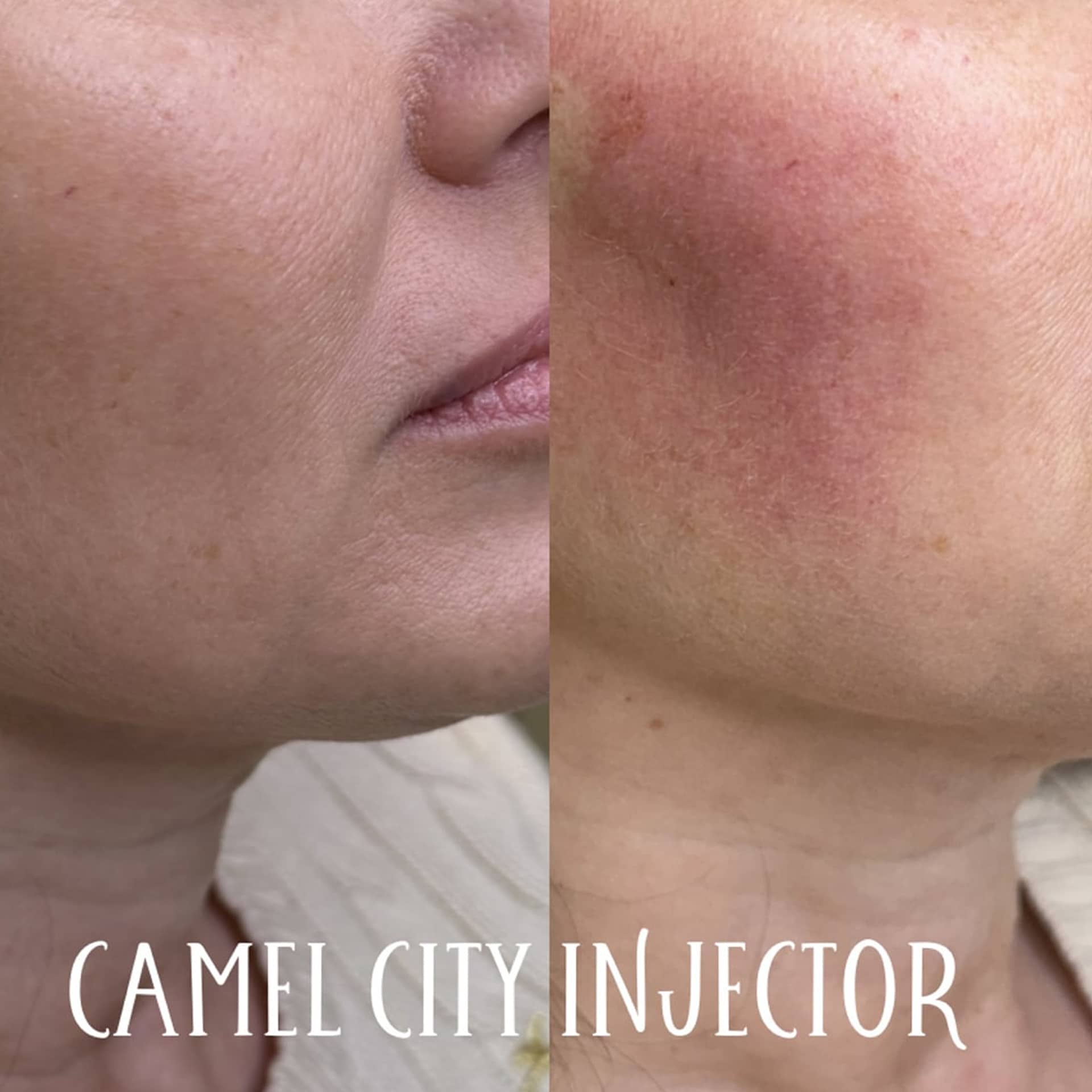 PDO Threads Subtle lift and collagen stimulation tattoo removal