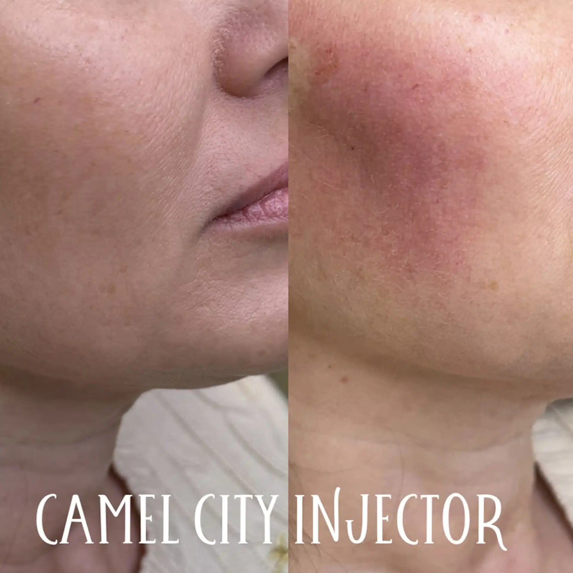 PDO Threads Subtle lift and collagen stimulation tattoo removal