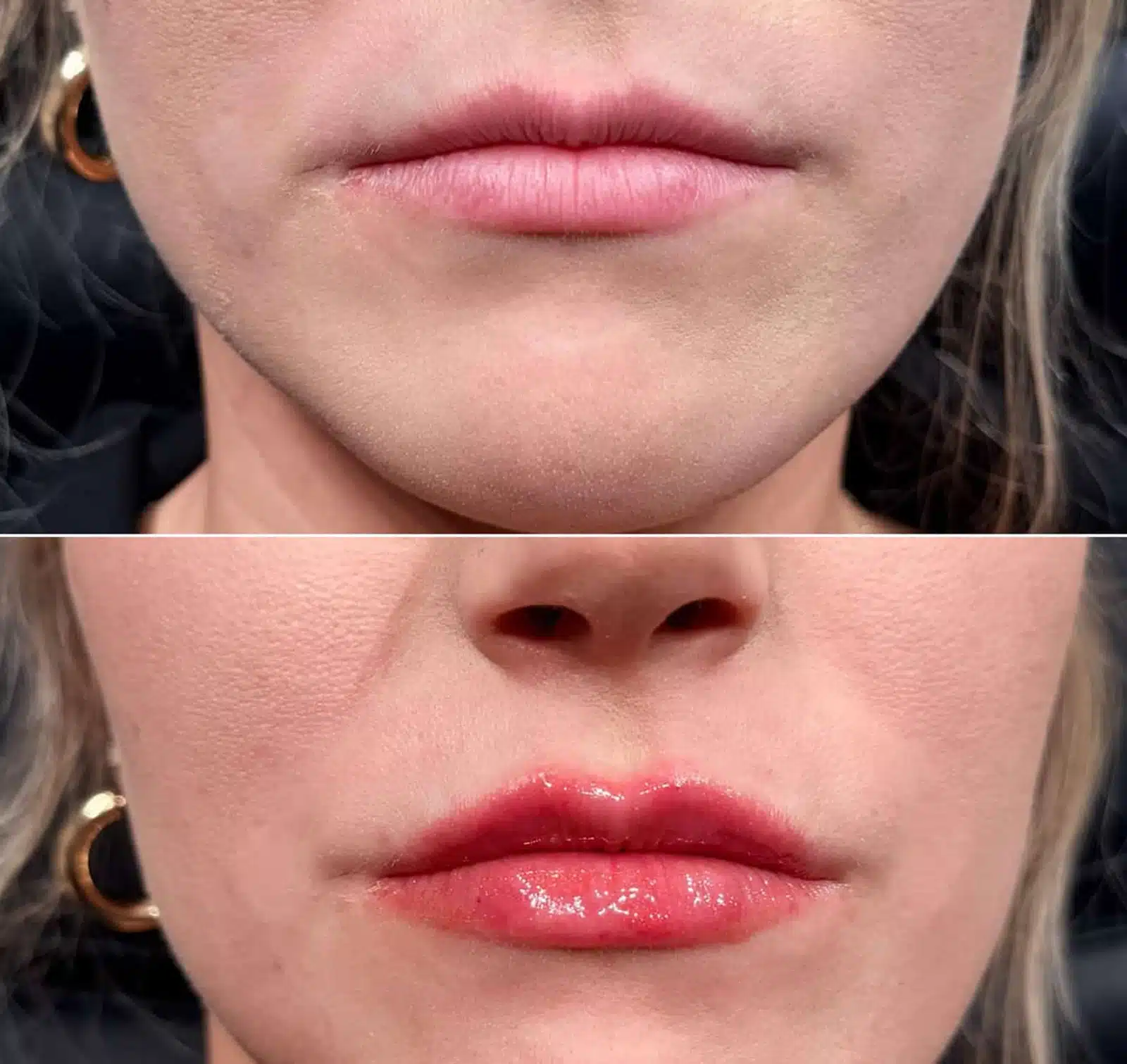 Lip Filler King