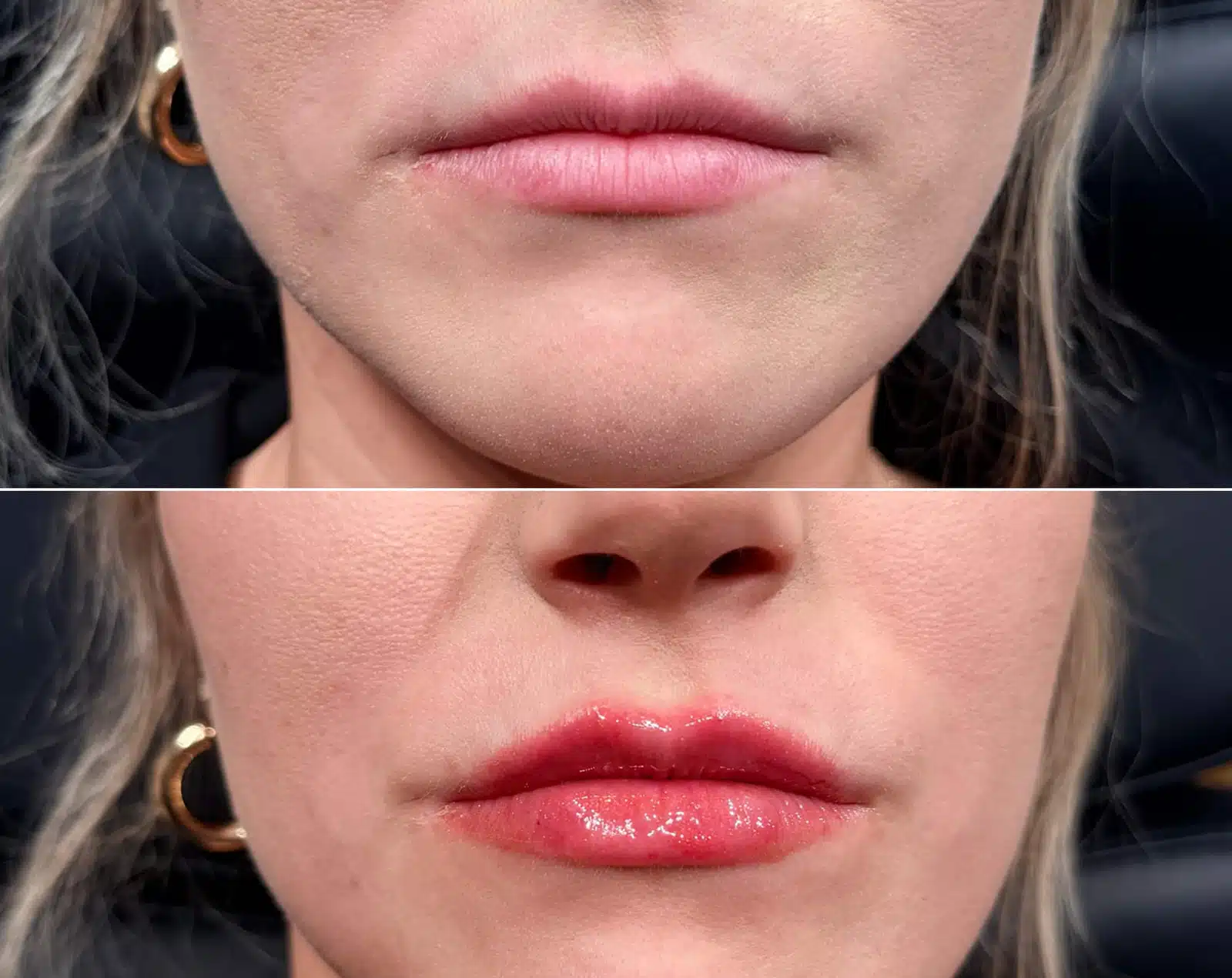 Natural-looking lip filler Winston-Salem