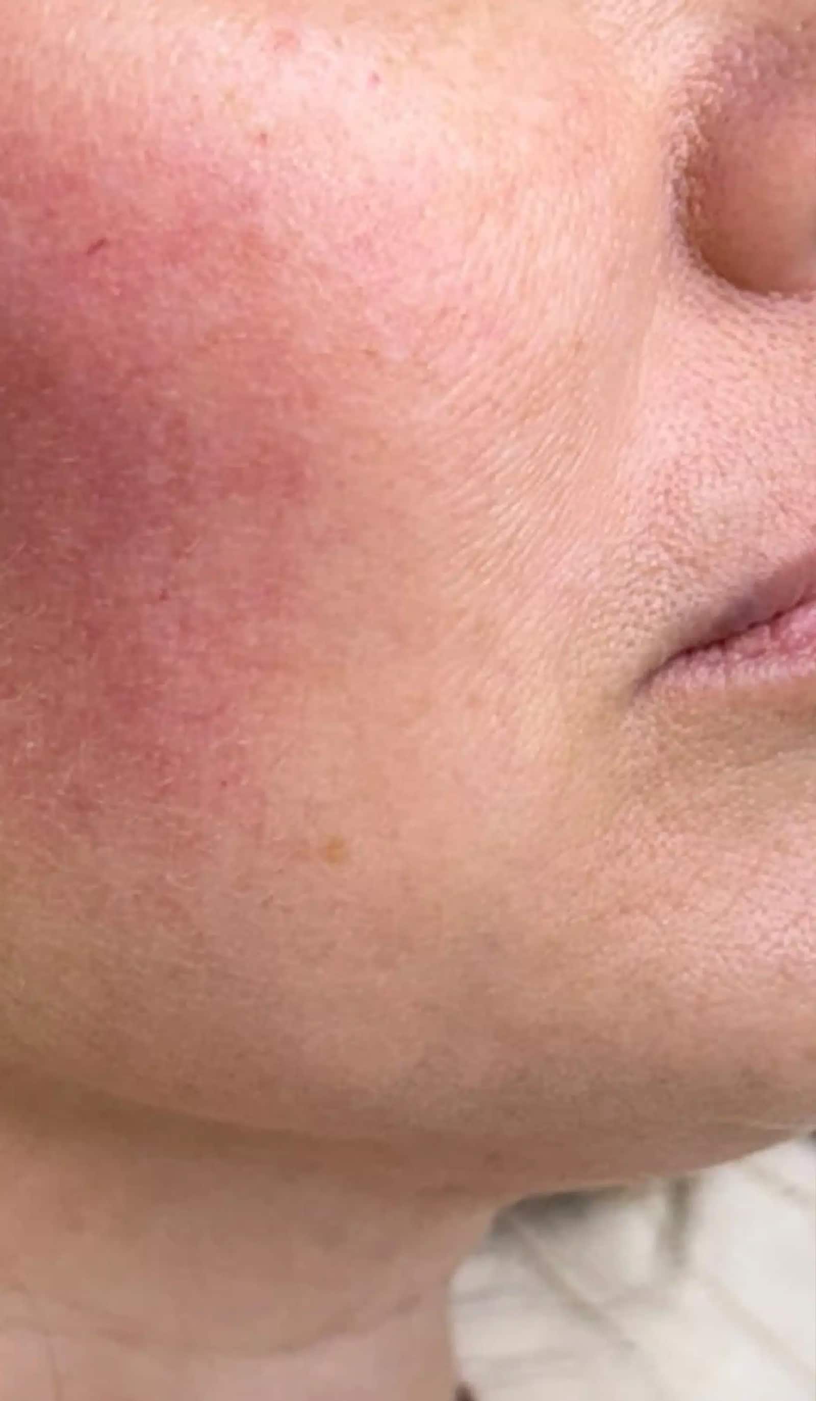 Treatment Experience at Camel City Injector Chemical Peels Treat