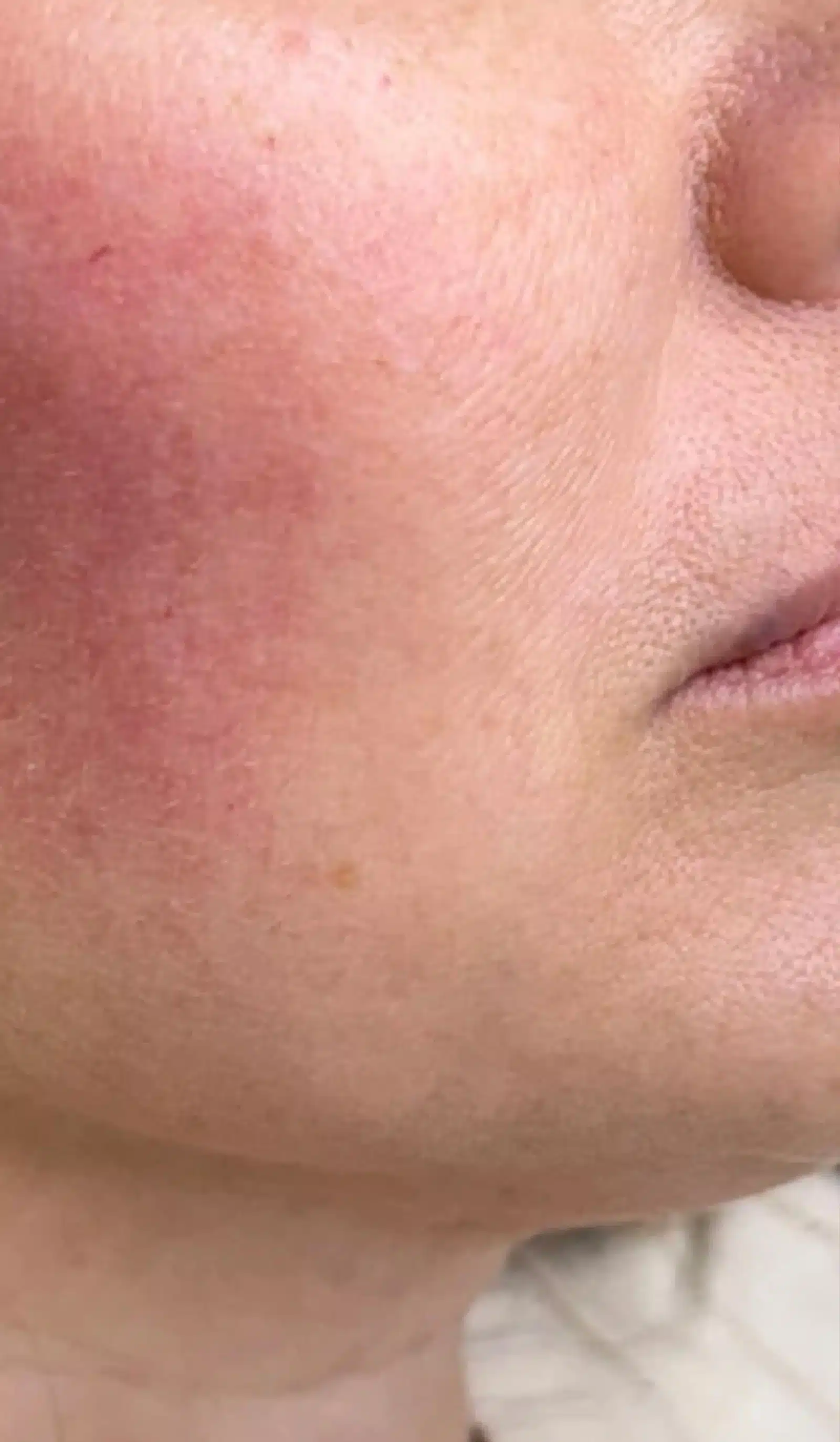 Chemical Peels Treat