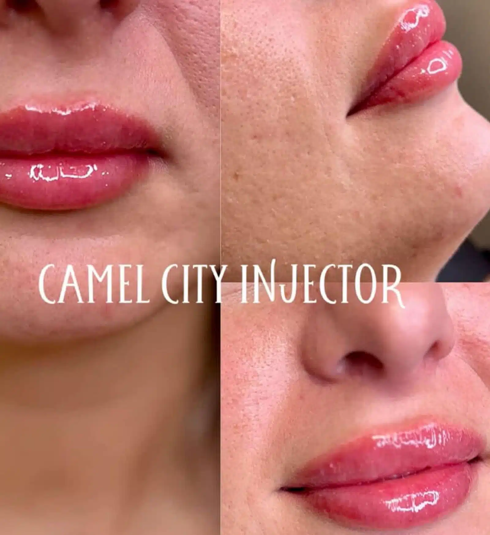 Treatment Fits Your Beauty Goals in King dermal filler designed to redefine