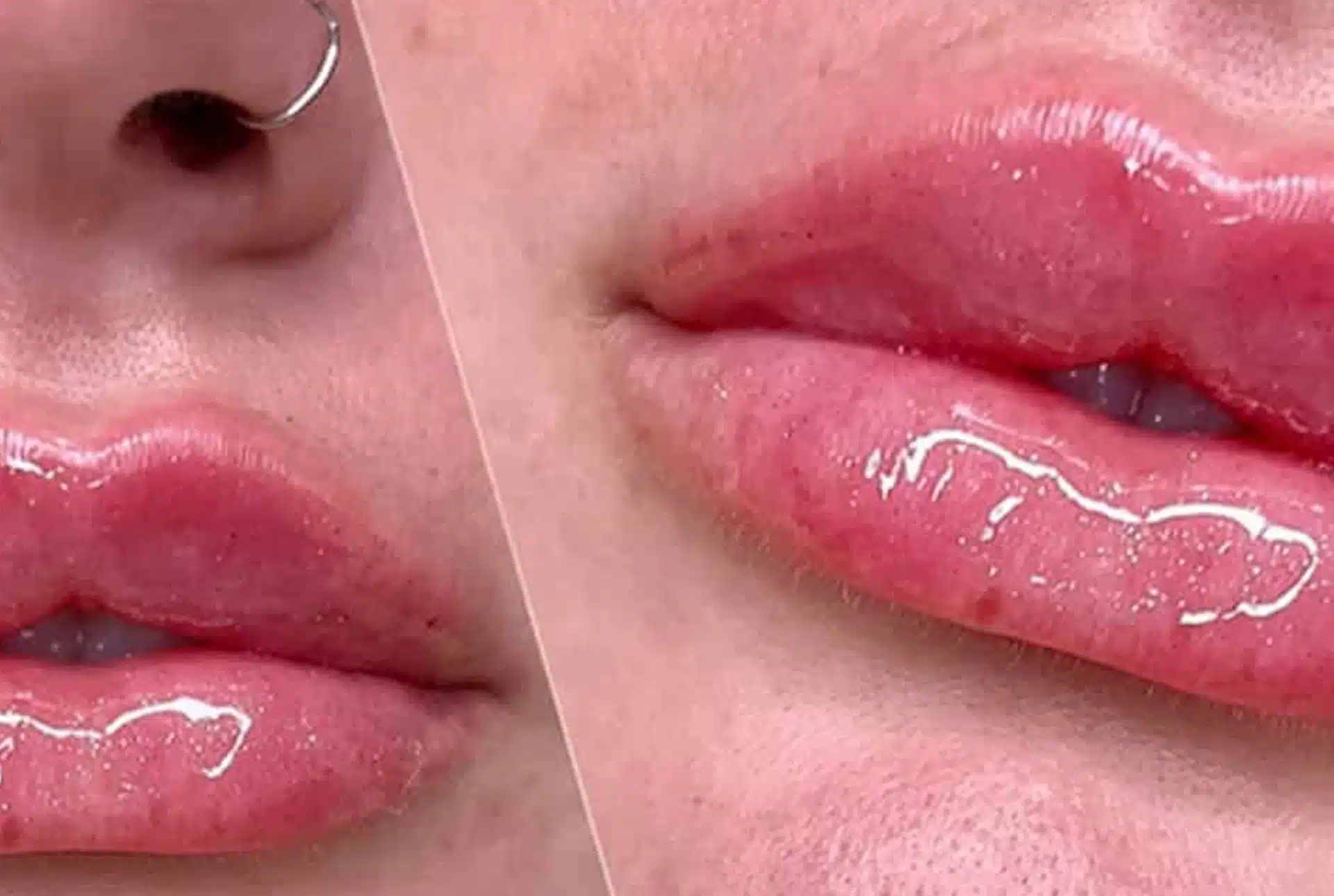 Lip Migration King