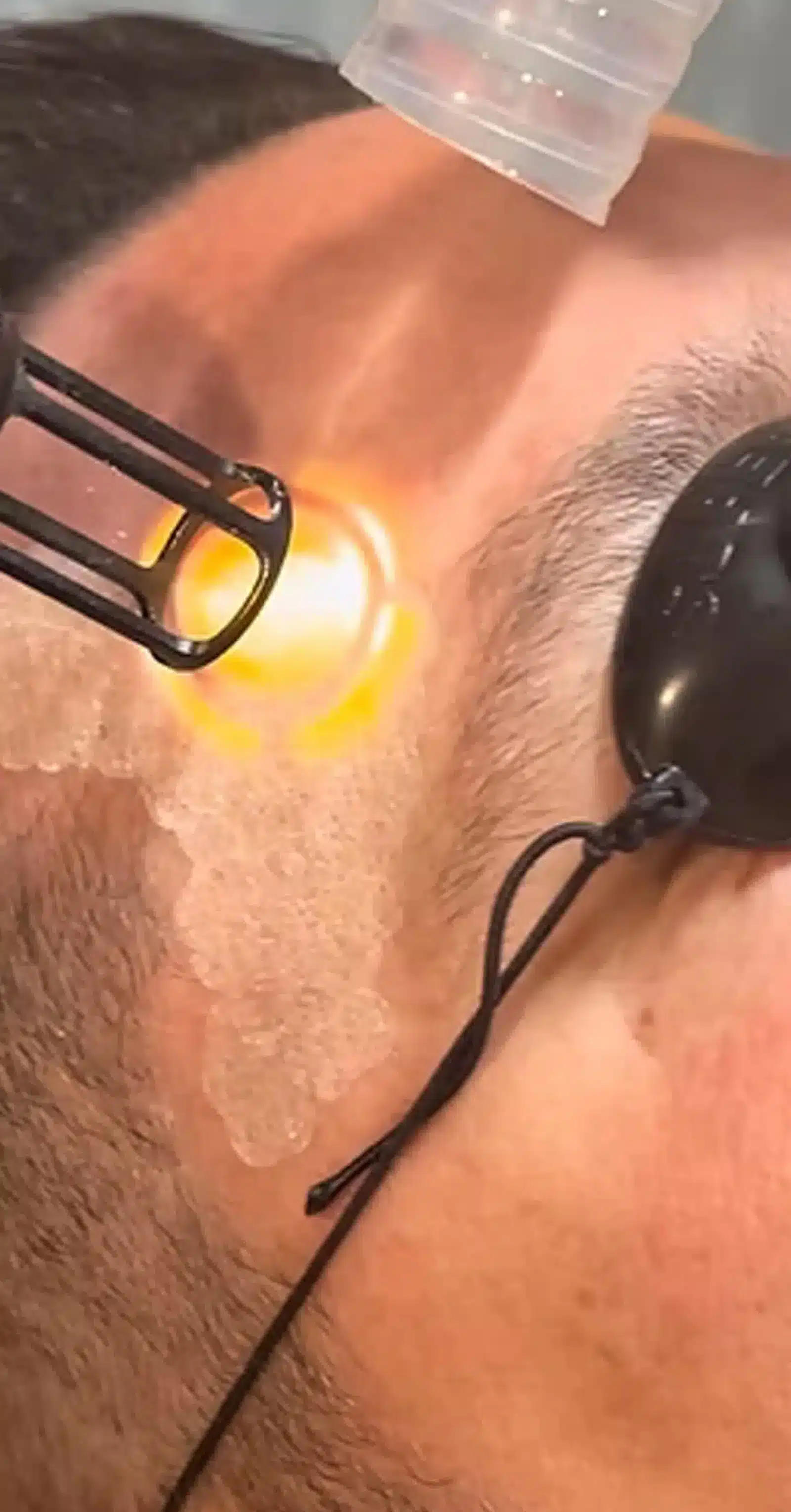 Camel City Injector for Laser Skin Resurfacing King Aftercare Tips for Optimal Results