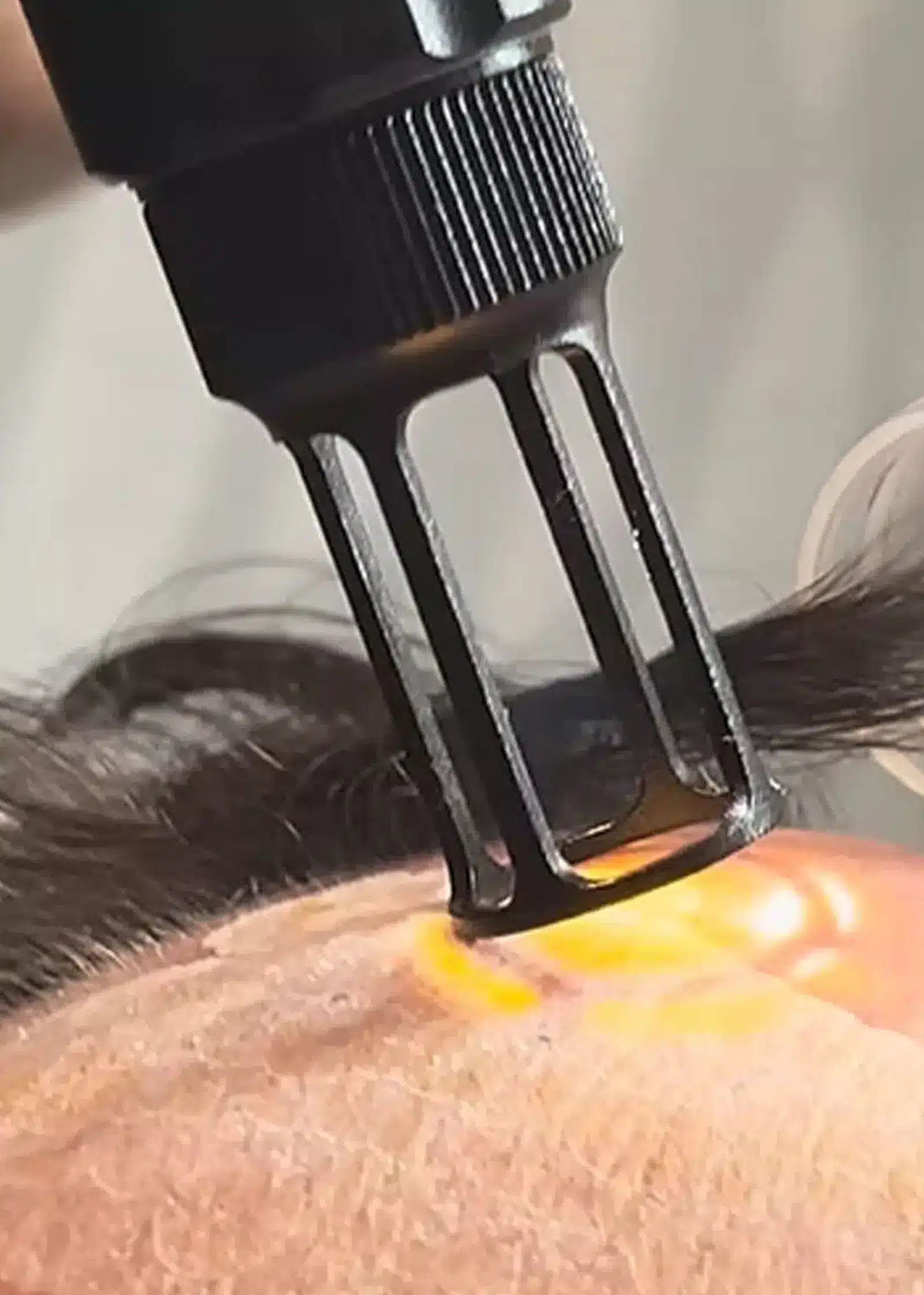 Laser Skin Resurfacing Recovery Aftercare Tips for Optimal Results
