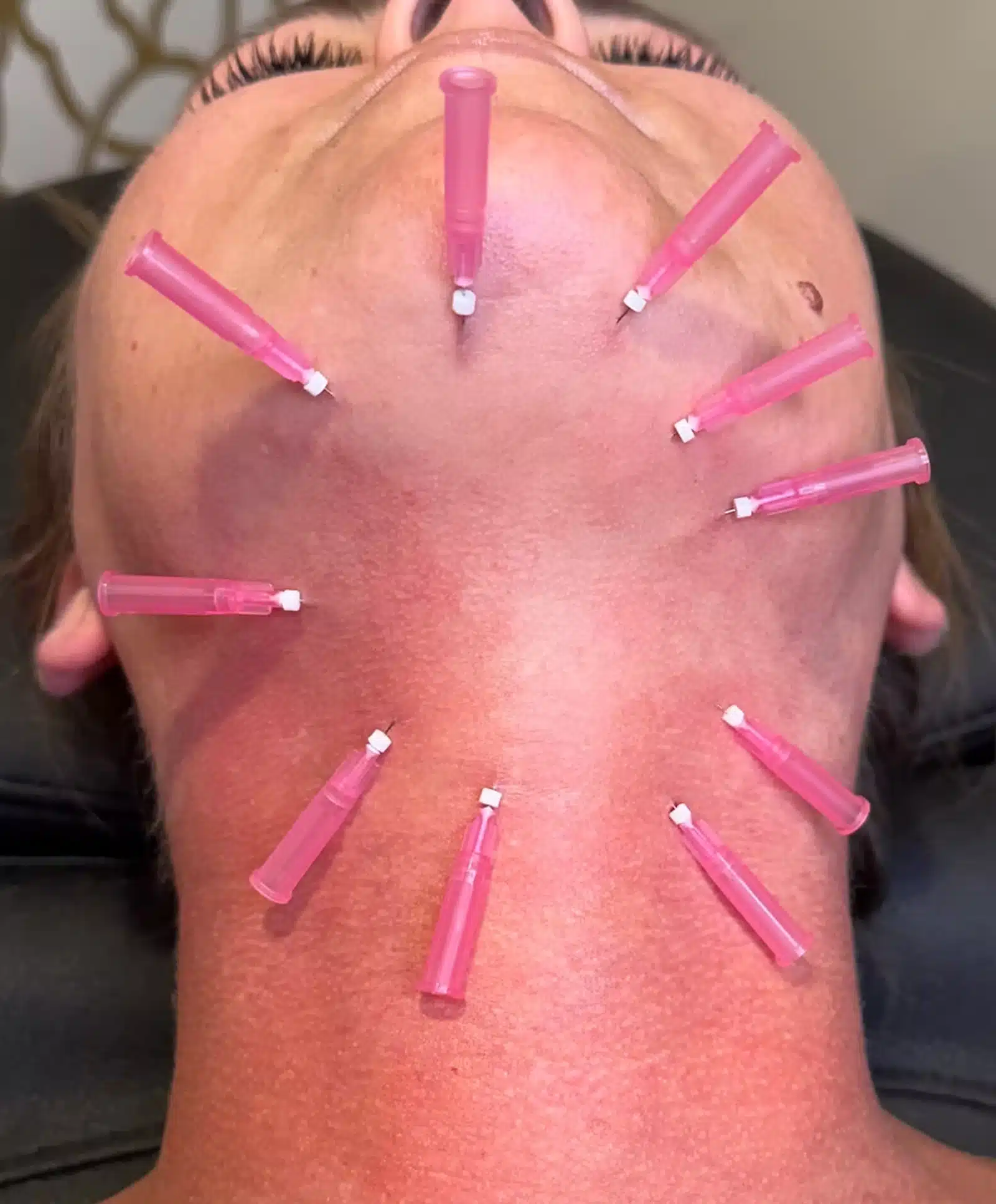 Chemical Peels Treat
