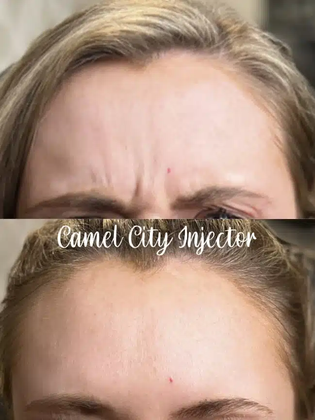Botox Winston Salem