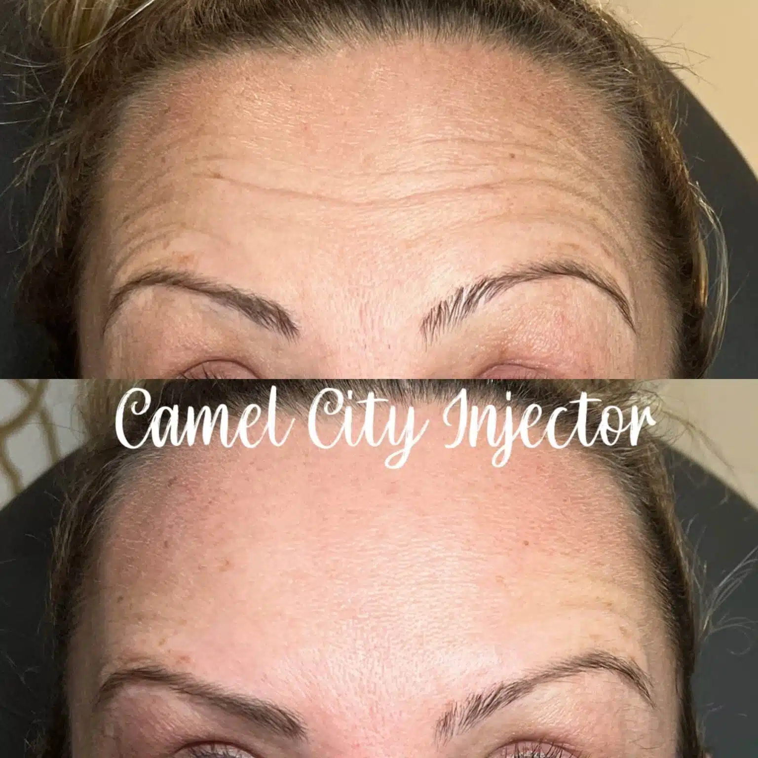 Botox before and after for forehead lines, Camel City Injector King, NC, Temporary and Adjustable Results